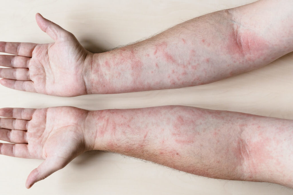 Humira Medication Uses for Psoriasis Treatment