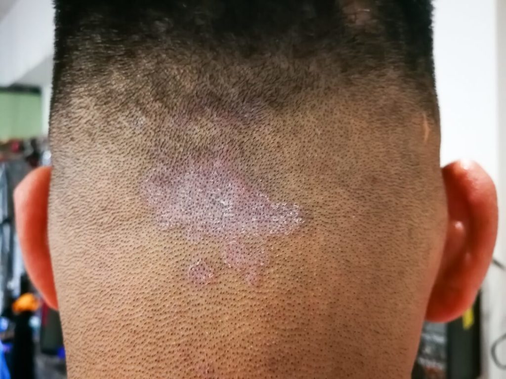 Dandruff Worm in Dry Scalp