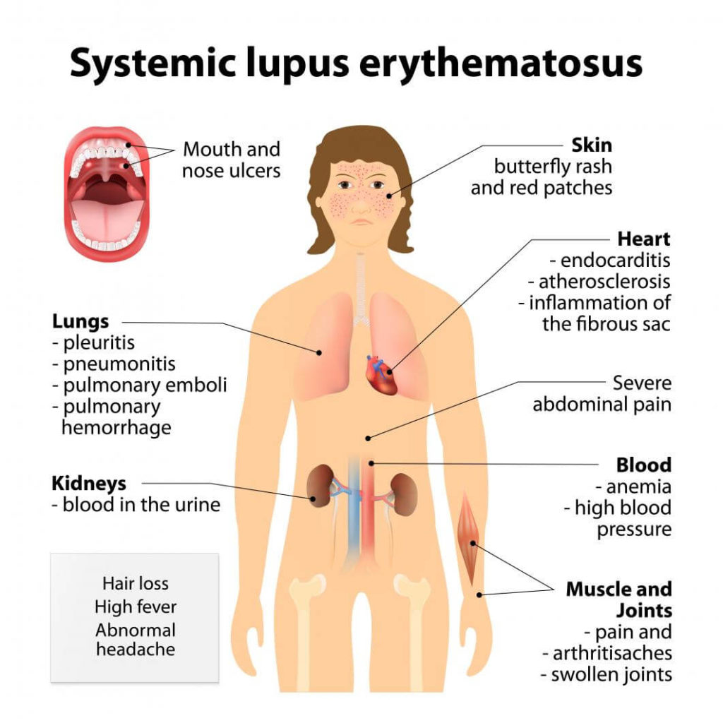 Lupus Symptom in Women - Picture of lupus disease locations in the body