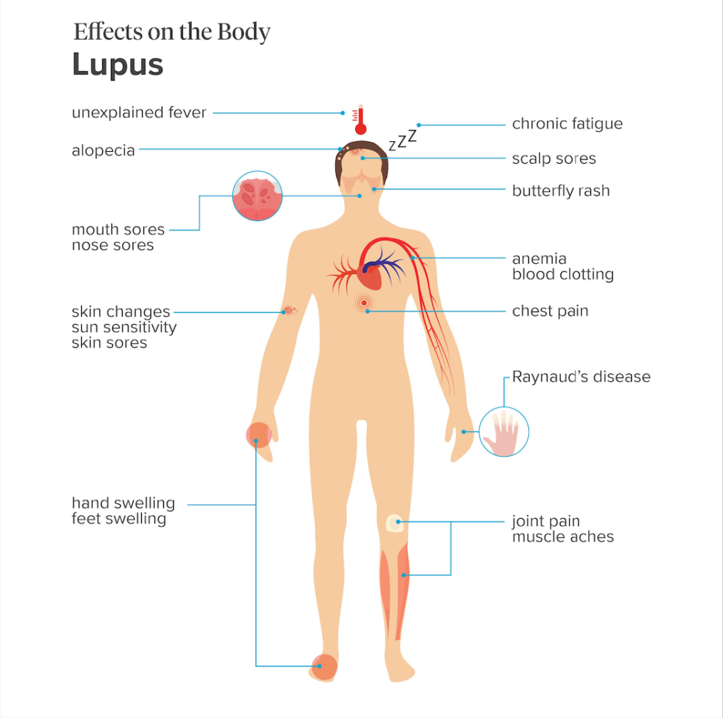Lupus symptoms and negative effects on the affected body parts