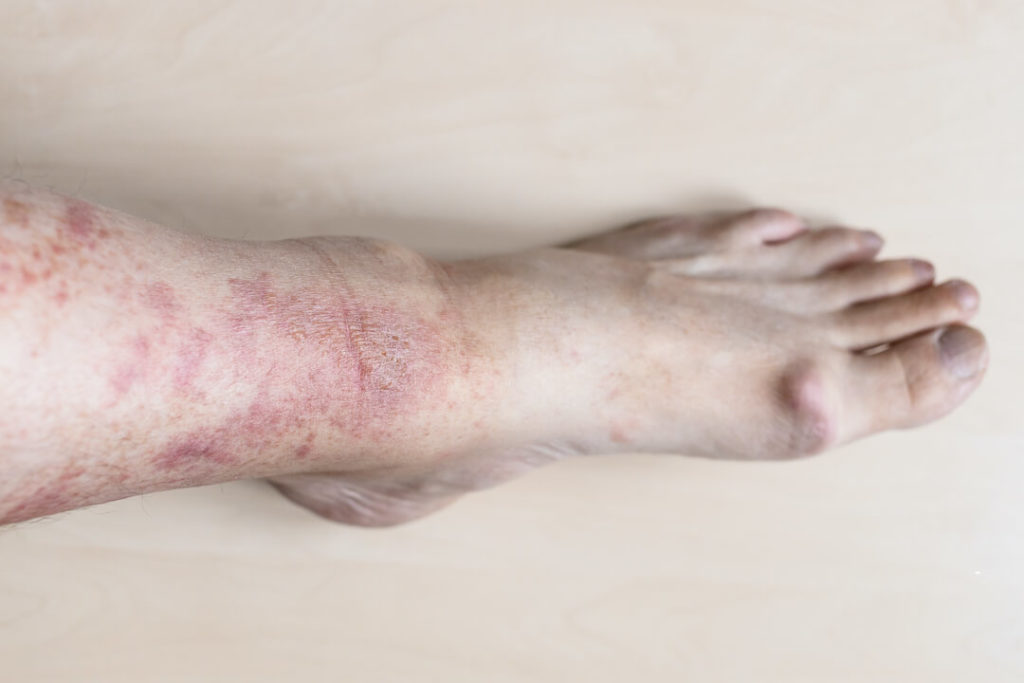 lupus symptoms in women - lupus feet pictures