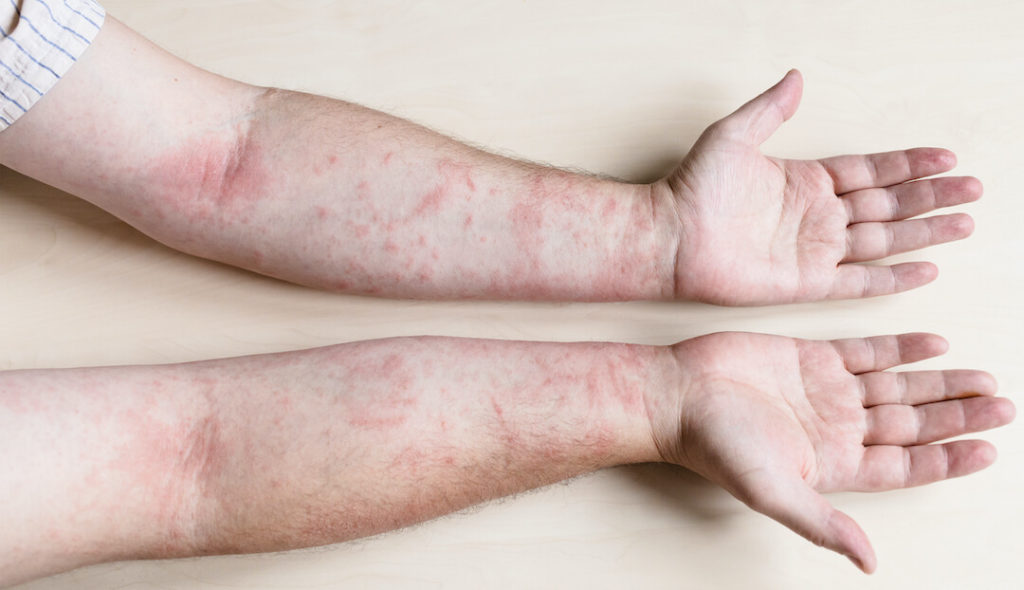 Allergy in Cold Weather - Hives or Rash on The Skin are Symptoms of Cold Urticaria