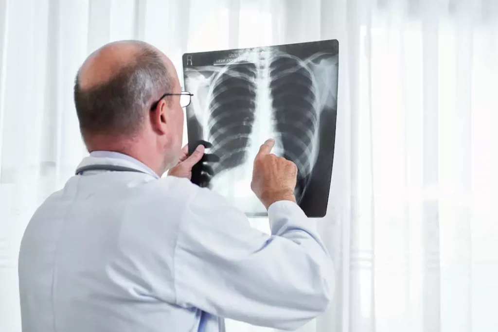 Inflammation of The Lungs - Doctor examining a chest X-Ray image of a patient