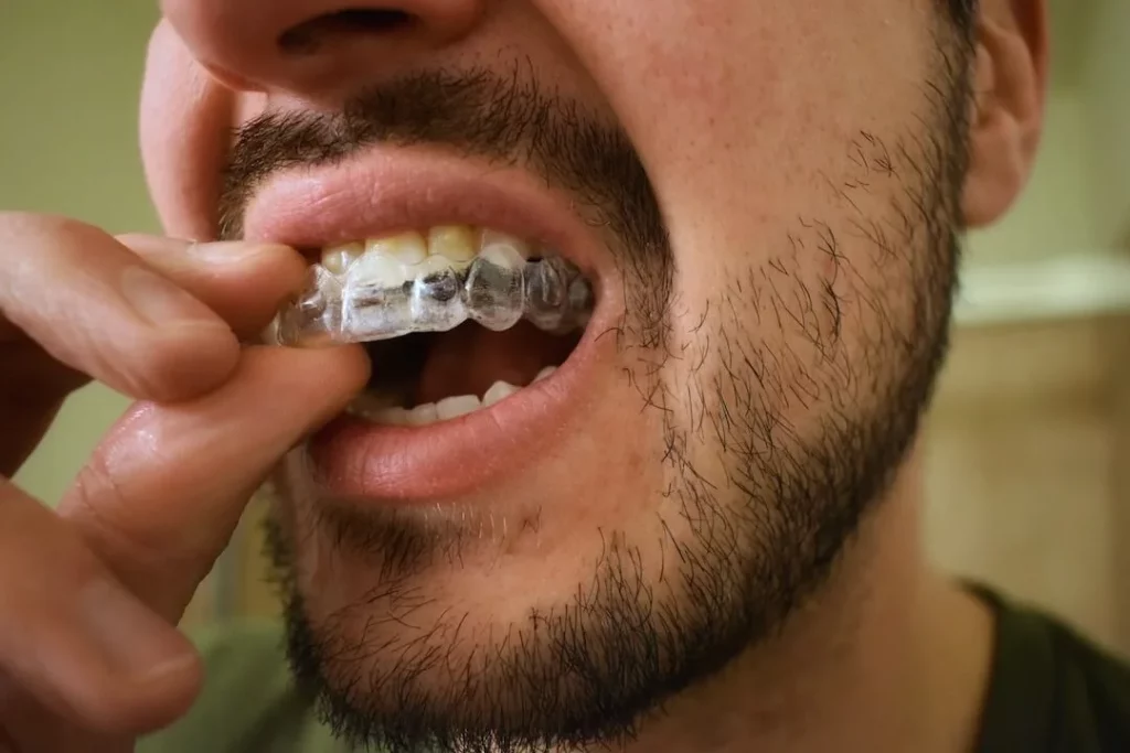 Types of Retainers - Man wearing invisible clear plastic retainers