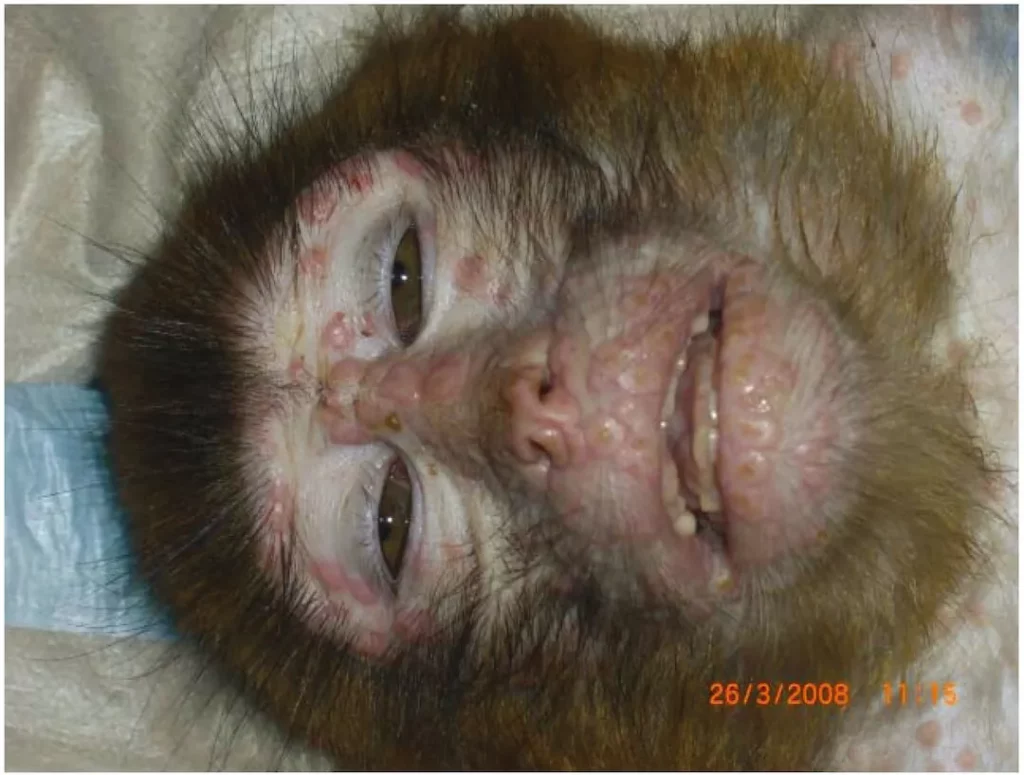 Monkeypox Virus - Monkey Face Blisters Photo