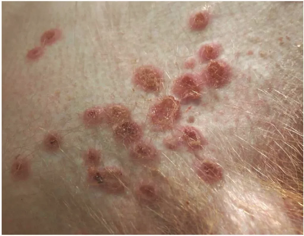 Monkeypox Virus - Skin Blisters Photo